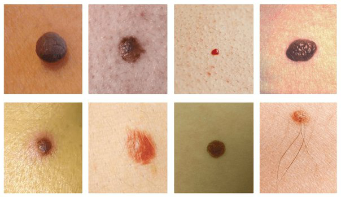 The most common skin spots nevus and papilloma (warts)