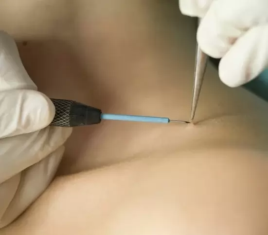 Removal of papillomas by electrocautery