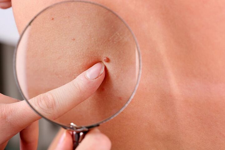 how to remove a wart on face