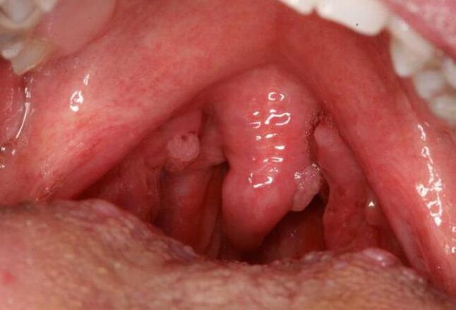 papilloma in throat