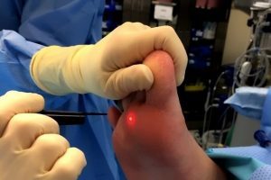 Surgical method to remove warts