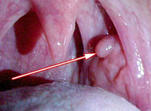 Papillomas in the larynx