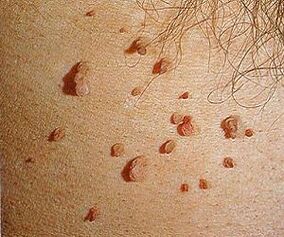 human papilloma virus on skin