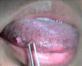 human papilloma virus on tongue