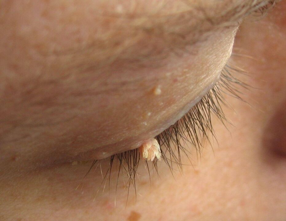 papillae on eyelids