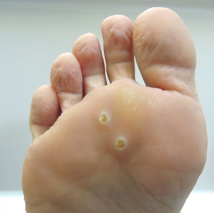 how to get rid of warts on feet