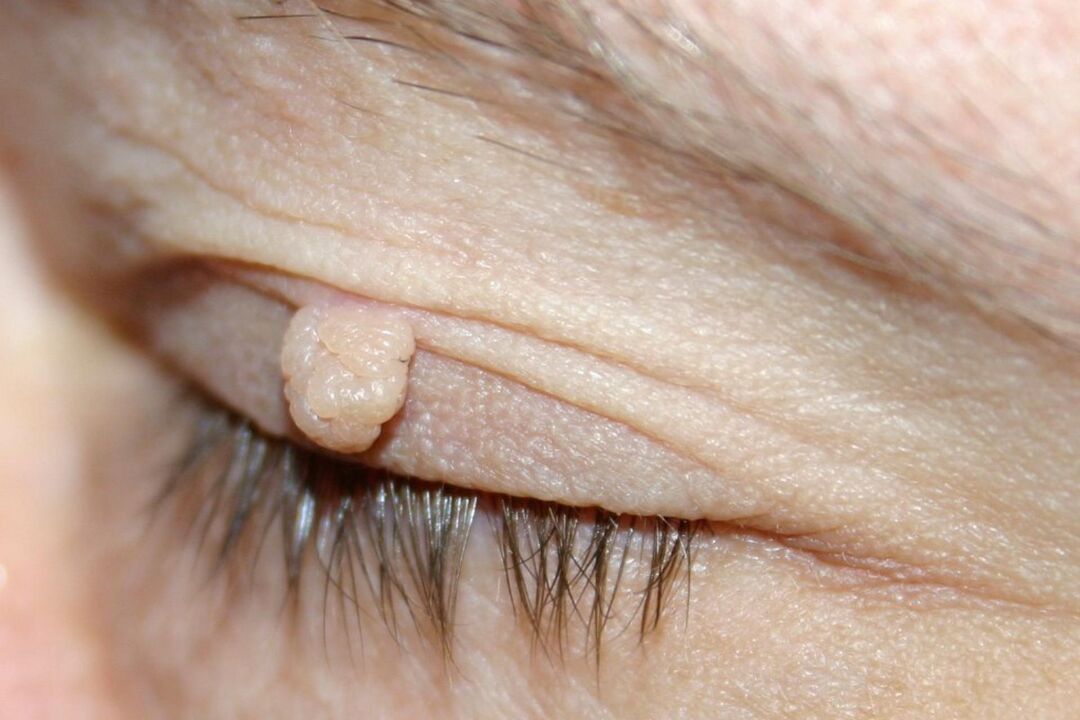 symptoms of papillomatosis on eyelids