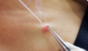 removal of papillae on the body with a laser