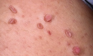 the cause of papillomas on the body